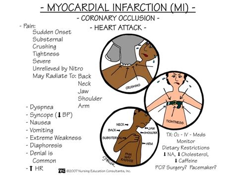 This is an nclex review for myocardial infarction (heart attack or mi). 1000+ images about Mnemonics RN on Pinterest | Nursing ...