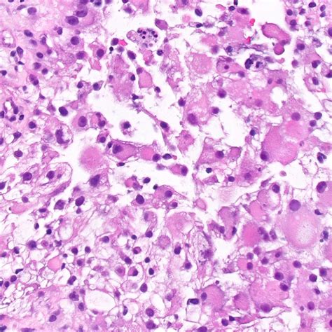 Pathology Outlines Rhabdoid Variant