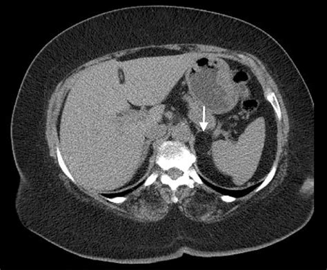 Adrenal Myelolipoma In A 60 Year Old Woman Unenhanced Axial Ct Image