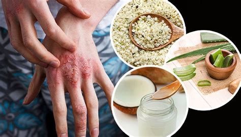 Eczema Is Common Skin Disorder Involving Inflamed Irritated And