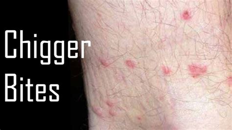 4 Ways To Treat A Chigger Bites Using Natural Remedies
