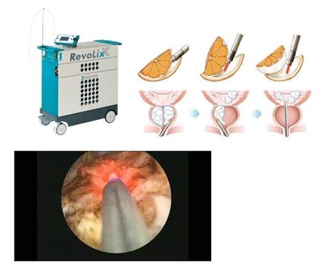 Holmium Laser Enucleation Of The Prostate Rela Hospital