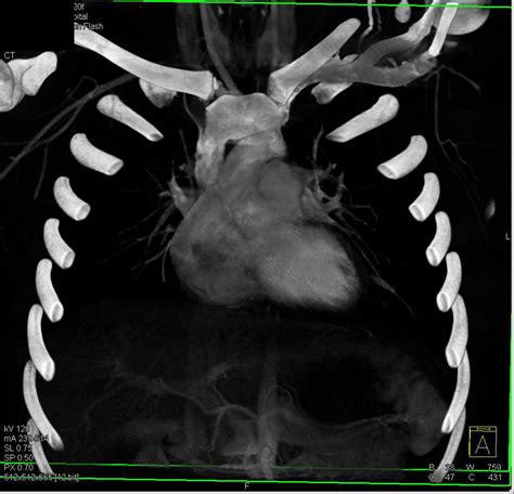 Chest Trauma With Clavicle Sternal Dislocation Trauma Case Studies