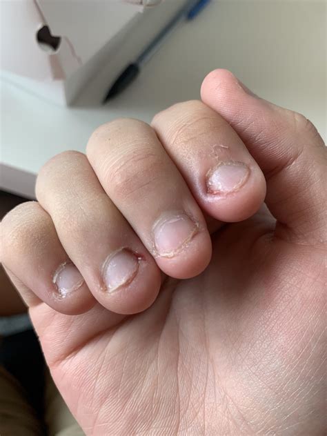 Where Do I Begin With Multiple Ingrown Fingernails This Has Sadly