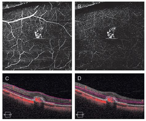 Myopic Degeneration Ento Key