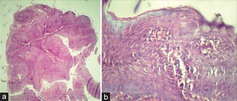 A Case Report Of A Recurring Verrucous Hyperplasia Revisit A