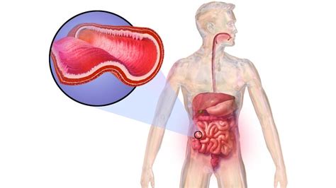 Doen A De Crohn O Que Causas Sintomas Diagn Stico E Tratamento