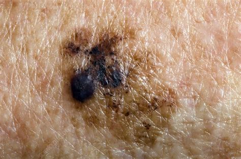 Melanoma Skin Cancer Spread Stock Image C0167370 Science Photo