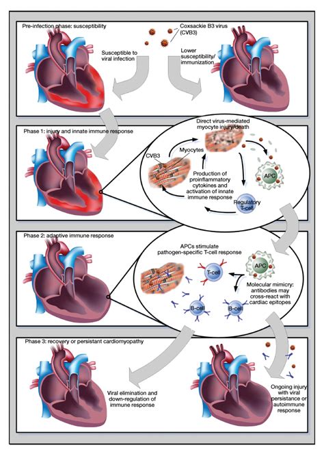 Pathophysiology of myocarditis the domino effect viral infection inflammation and injury decreased myocardial contractility 11. International Medical Press - Browse Articles
