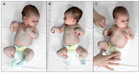 Radial Nerve Palsy In The Newborn A Case Series Cmaj