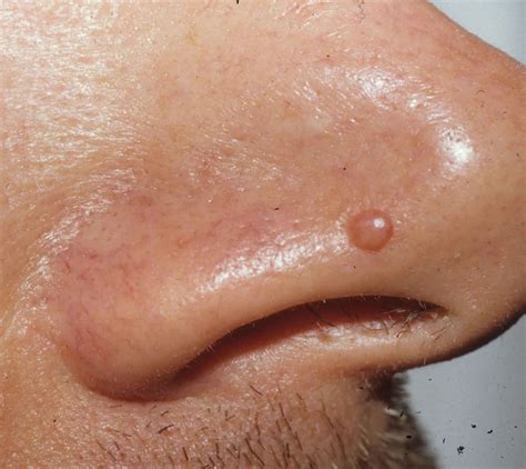 Papilloma Virus Nasale Enterobiasis Causative Agent Hot Sex Picture