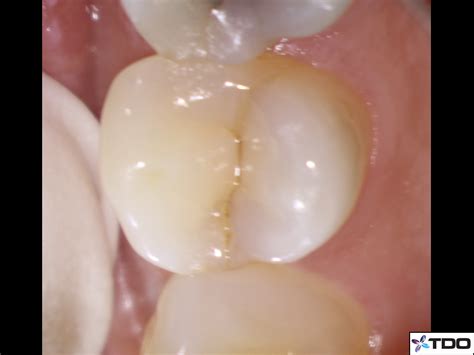 march 2018 cracked virgin maxillary premolar endoexperience