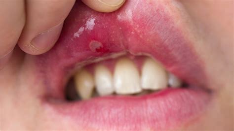Canker Sore Roof Of Mouth Images 12300 About Roof