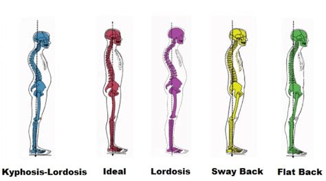 28 Lumbar Lordosis Kyphotic Posture