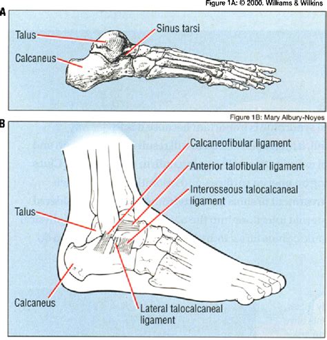 Figure 1 From The Sinus Tarsi Syndrome A Cause Of Chronic Ankle Pain