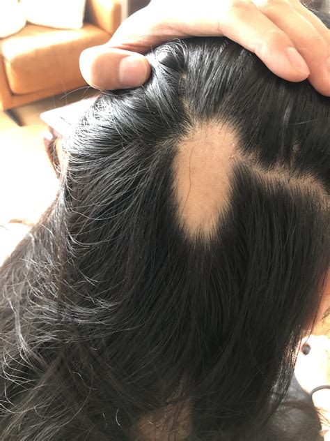 Anyone Have Any Idea What Has Happened Here Sudden Hair Loss In This