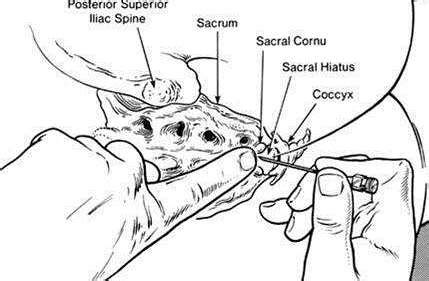 (lateral caudal epidural steroid injection diagram: ANAESTHESIA TODAY: CAUDAL EPIDURAL BLOCK, A REVIEW.