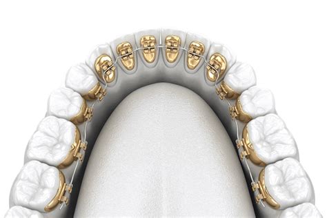 Lingual Braces Hidden Incognito™ Braces Smartdontics® Orthodontics
