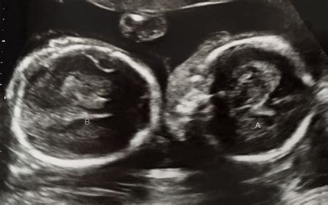 21 Weeks Ultrasound21weeks Twiniversity