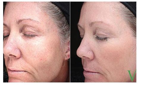 Vi Peel Before And After Darst Dermatology Charlotte Dermatologist