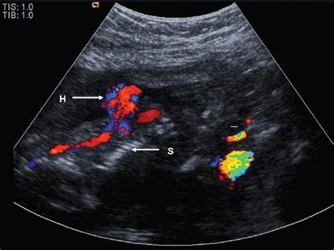 Fetal Ultrasound Scan Showing The Ectopia Cordis Download Scientific