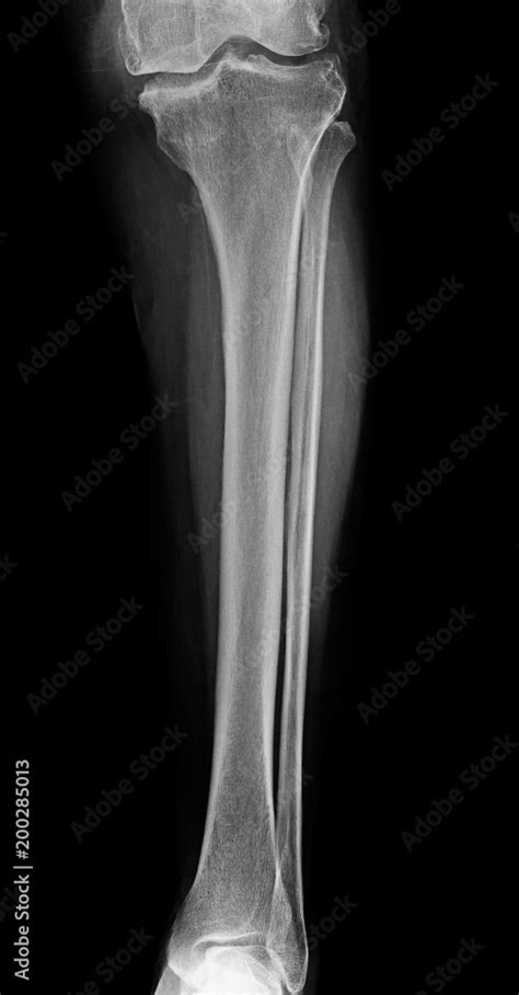 Lower Leg Xray X Ray Image Of Leg Front View Xray Of Normal Leg Bone In Adult Stock Photo