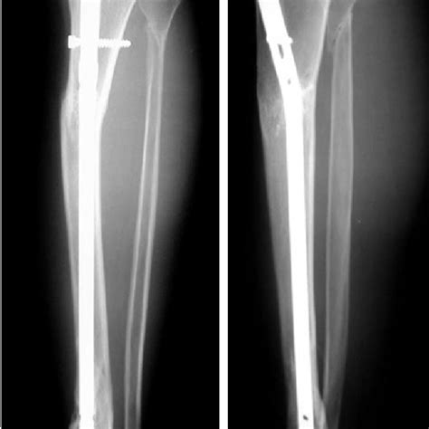 Lateral Radiograph Of The Proximal Tibial Fracture Treated With An Ao