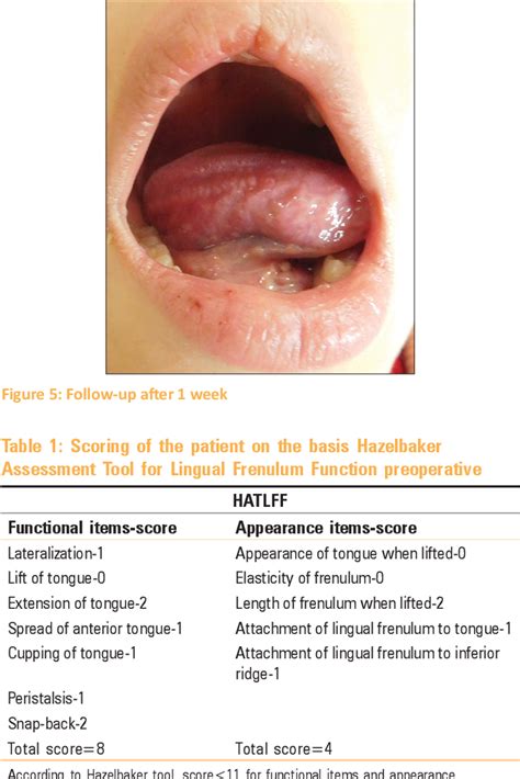 Treatment Of Partial Ankyloglossia Using Hazelbaker Assessment Tool For Lingual Frenulum