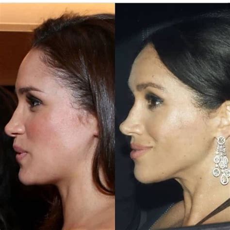 What Kind Of Nose Did Meghan Markle Have Before Plastic Surgery Quora