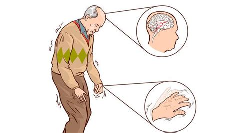 Leczenie Choroby Parkinsona Dr N Med Specjalista Neurolog