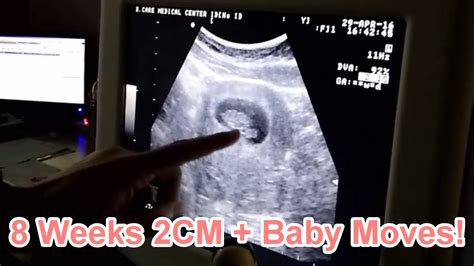 Ep1 Ultrasound 8 Weeks Pregnant Found Ovarian Cysts Youtube