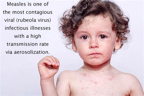 10 Common Childhood Infectious Diseases Emedihealth