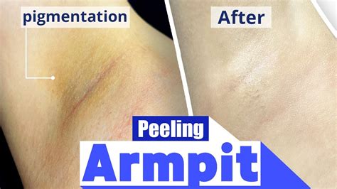 Armpit Peeling Procedure Before And After Seanergy Peel Youtube