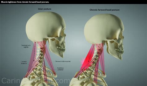 Forward Head Posture Symptoms And Complications