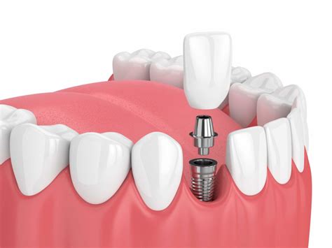 Dental Implants Morehead City Nc Sound Dental