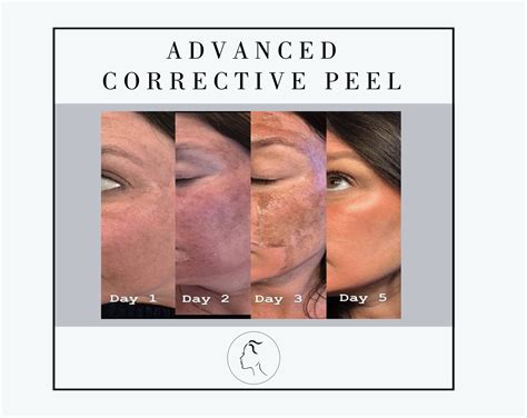 Facial Aesthetic Center Chemical Peel Gallery