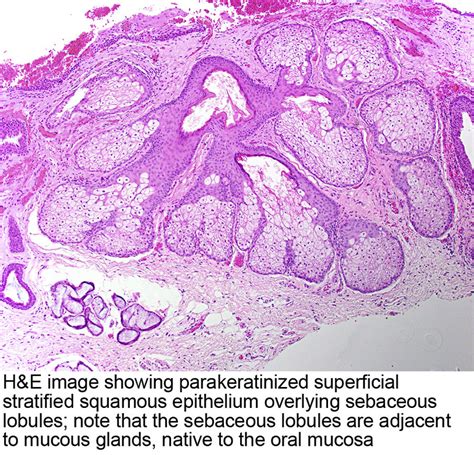 Pathology Outlines Fordyce Granules