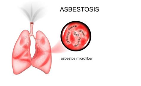 Asbestosis In Lungs Causes Symptoms Treatments And Complications