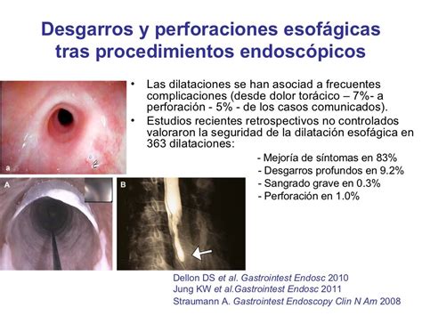 Esofagitis Eosinofílica Actualización Clínica Y Patológica