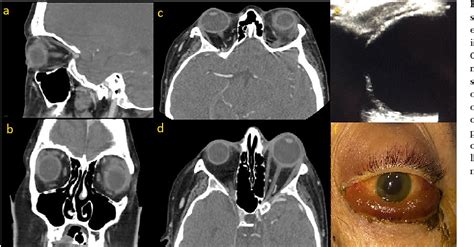 Figure 1 From Spontaneous Orbital Hemorrhage In A Case Of Acute Liver