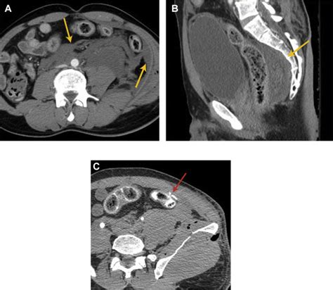 Imaging Of Gastrointestinal Tract Perforation Radiology Key