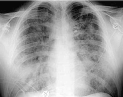 Posteroanterior Chest X Ray Of Acute Idiopathic Eosinophilic Pneumonia