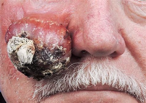 Squamous Cell Carcinoma Stock Image C0402899 Science Photo Library
