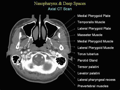 Nasopharynx Deep Spaces In The Axial Ct Scan Medizzy