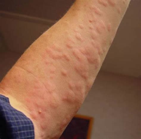 Urticaria Relief From Hives And Eczema Rashes In Under One Minute