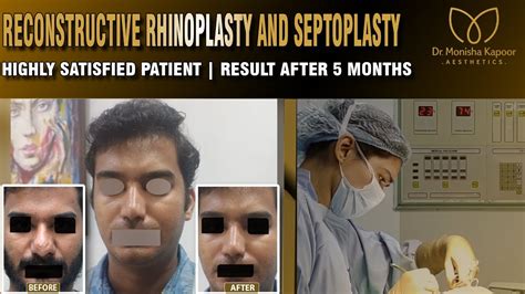 Dr Monisha Kapoor Aesthetics Your Trusted Delhi Surgeon For Revision Rhinoplasty Nose Job