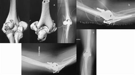A Dubberley Type 3b Fracture Associated With Fracture Of Medial And