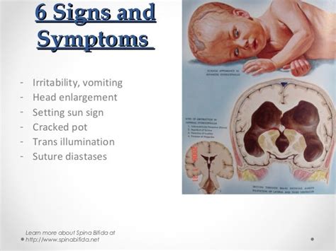 6 Symptoms Of Hydrocephalus In Babies