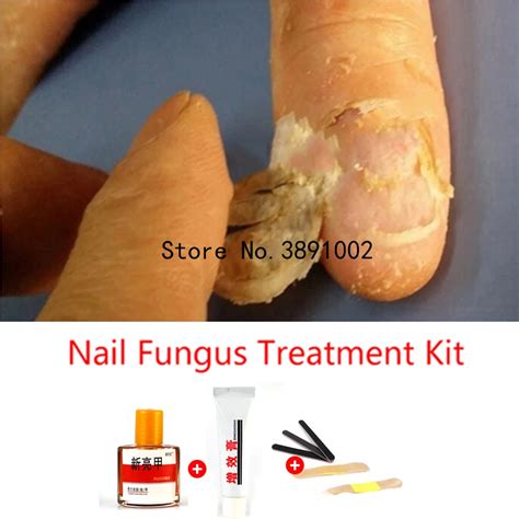 Herbal Fungal Nail Treatment Essence Toe Nail Finger Anti Fungus