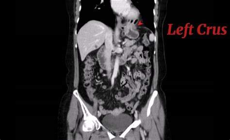 Figure Ct Scan Coronal View Showing Left Crus Of Diaphragm